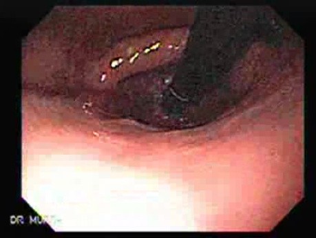 Endoscopy of Mallory Weiss Tear - 58 Years-Old Female