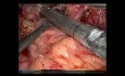 Robotic Transhiatal Esophagectomy for Locally Advanced Adenocarcinoma