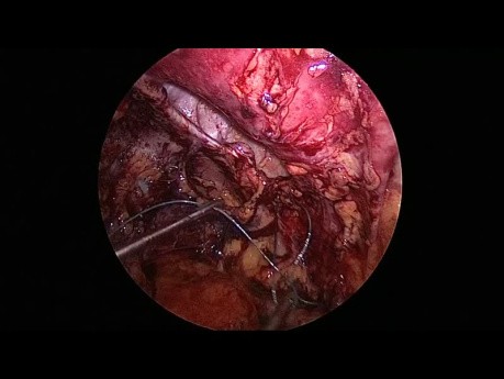 Laparoscopic Transabdominal Preperitoneal Left L4 Hernia Repair