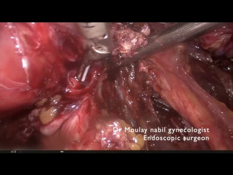 Complex hysterectomy on severe endometriosis