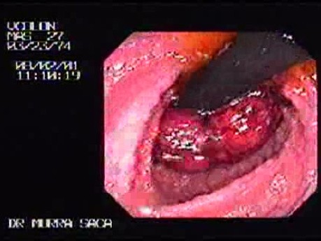 Familial Adenomatous Polyposis of the Colon (8 of 29)