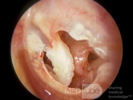 Cholesteatoma