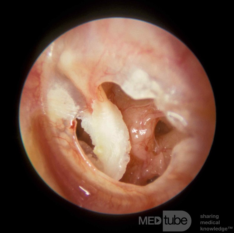 Cholesteatoma