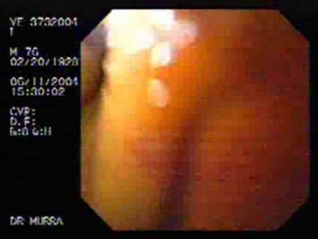Yellowish endoscopical larynx view during ictericia