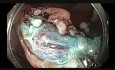 Colonoscopy - Cecal Large Endoscopic Mucosal Resection