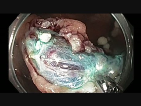 Colonoscopy - Cecal Large Endoscopic Mucosal Resection