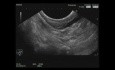  Endoscopic Ultrasound of Gastric Antral Submucosal Lesion