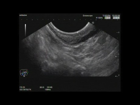  Endoscopic Ultrasound of Gastric Antral Submucosal Lesion