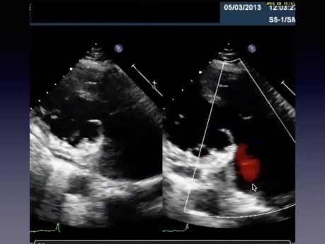 Why is My Patient in CHF？Challenging Echo Cases with Tips and Tricks