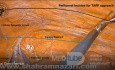 Landmarks for Laparoscopic TAPP Hernia Repair