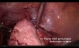 Myomectomy with Transitory Vascular Control