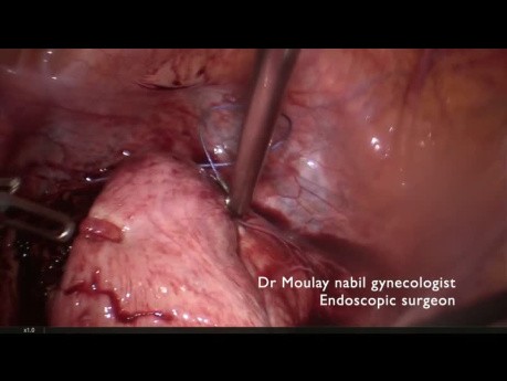 Myomectomy with Transitory Vascular Control