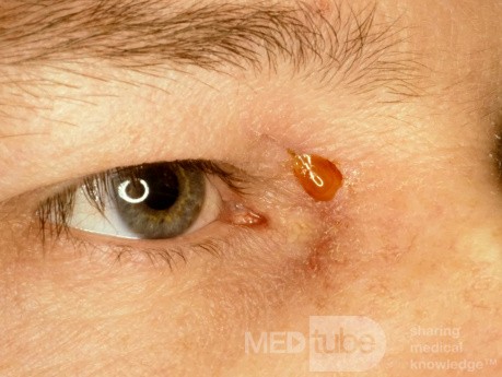 Frontal Sinus Fistula