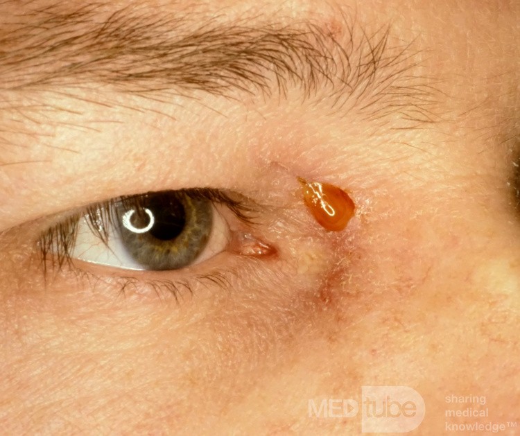 Frontal Sinus Fistula