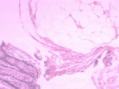 Colonic Lipoma (4 of 4)