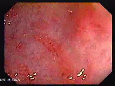 Endoscopic View Of Diverticulitis Of The Sigmoid (3 of 4)