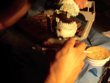 Diagnostic Waxup Part 6