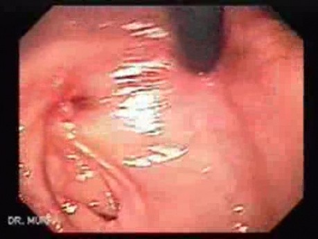 Colonic Interposition for Esophageal Substitution (9 of 11)