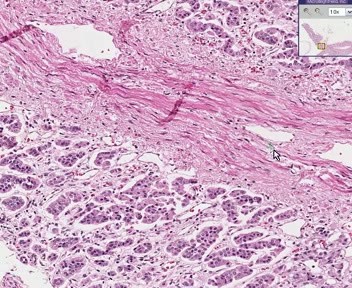 Adrenal - Atrophy