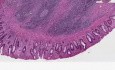 Ulcerative colitis, carcinoma, atypia - Histopathology - Colon