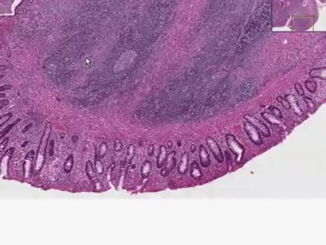 Ulcerative colitis, carcinoma, atypia - Histopathology - Colon