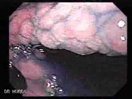 Follicular Lymphoid Hyperplasia (3 of 4)