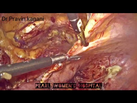 Ureteric Implantation with Boari Flap