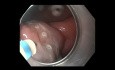Early Gastric Cancer Treatment