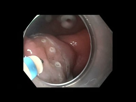 Early Gastric Cancer Treatment