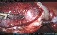 Excision of Bilateral Endometriomas