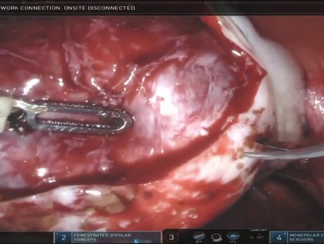 Excision of Bilateral Endometriomas
