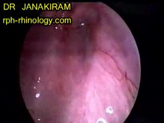 Aberrant Carotid Artery