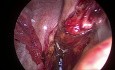 SILS Using a Magnet Retractor in Low Anterior Resection