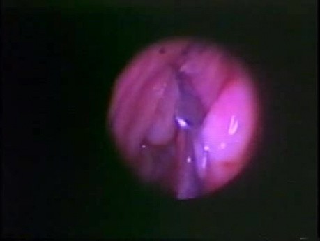 Functional Endoscopic Sinus Surgery - Anatomical Demostration - Part 2 of 5