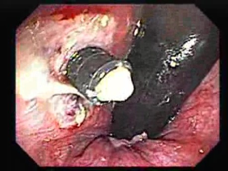 Rubber Band Ligation of Hemorrhoids (3 of 3)