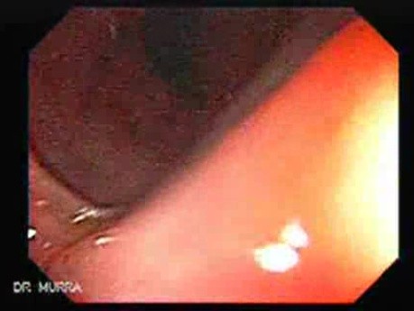 Consecutive colonoscopy with dilation was carried out (12 of 15)