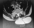 Meningocele in an 18-year-old patient