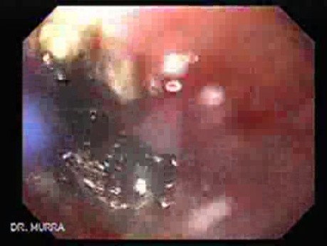 Adenocarcinoma of the Gastroesophageal Junction - Lumen Restoration
