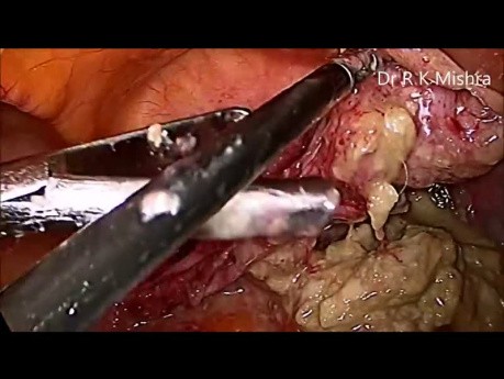 Myomectomy and Dermoid Ovarian Cystectomy