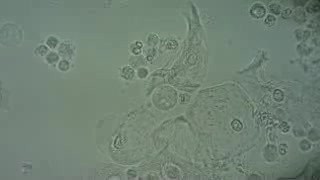 Trichomoniasis - Trichomonas vaginalis