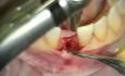 Implant Microsurgery: Implant Replaces Failing Lower Central