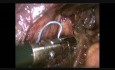 Laparoscopic Assisted Duodenopancreatectomy for Vaterian Ampulloma in an Obese Patient