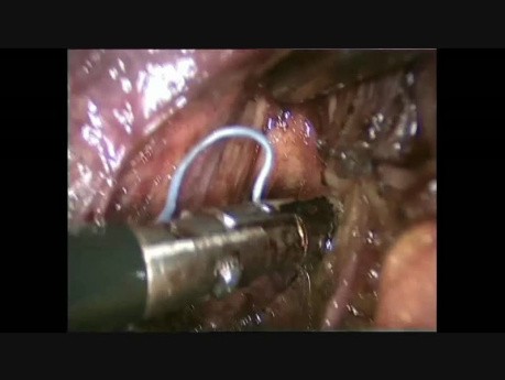 Laparoscopic Assisted Duodenopancreatectomy for Vaterian Ampulloma in an Obese Patient