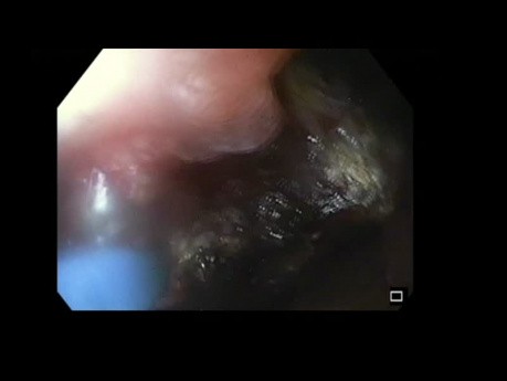 Argon Plasma Coagulation for Ampullary Tumor