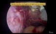 Total Laparoscopic Hysterectomy for a Fibroid Uterus Using a Single Hybrid Energy Device