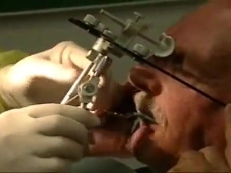 Dentures - Wax Rim Appointment - Wax Esthetics, Speech, CR, VDO