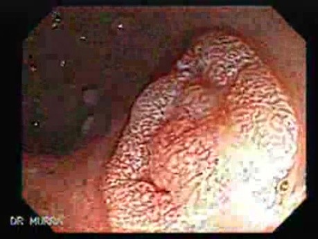 Familial Adenomatous Polyposis (3 of 36)