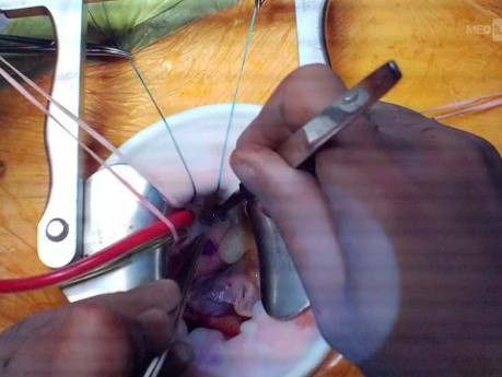 Right Anterolateral Thoracotomy for AVR and MVrep