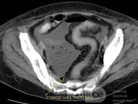 Multiple Rectal Ulcers (42 of 110)
