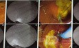 Liver Hydatid Cyst Profection to CBD and Cholangitis and Extraction of Doughter Cyst with ERCP